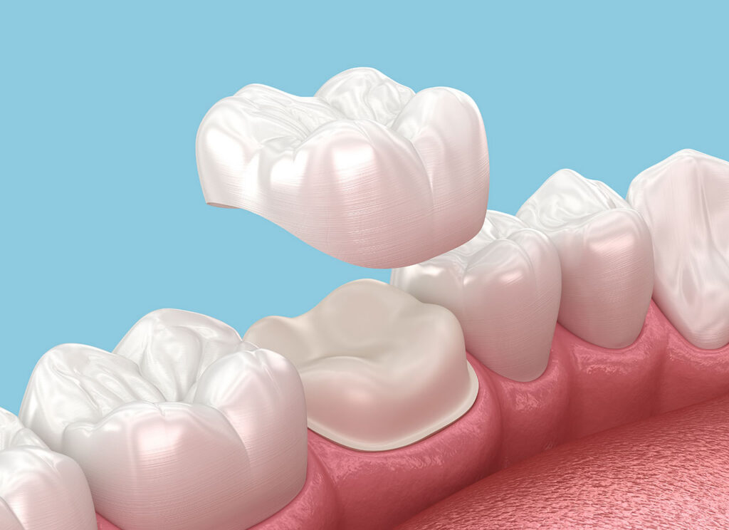 Dental Crowns in Chicago: A Strong, Natural-Looking Way to Repair Damaged Teeth