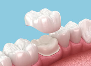 Dental Crowns in Chicago: A Strong, Natural-Looking Way to Repair Damaged Teeth