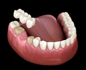 Dental Bridges in Chicago: When Is a Bridge the Right Choice for a Missing Tooth?